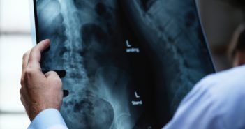 Calcio, fragilità ossea e latte: tutta la verità (quella scientifica)